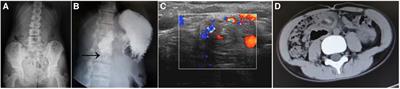 Identification and treatment of intestinal malrotation with midgut volvulus in childhood: a multicenter retrospective study